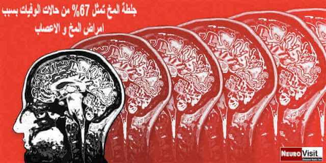 جلطة المخ و الزهايمر