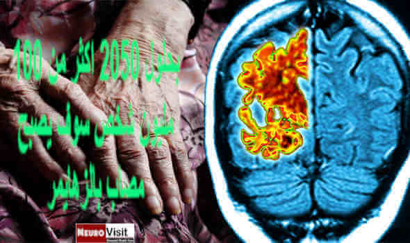الزهايمر و الجلطة 2020